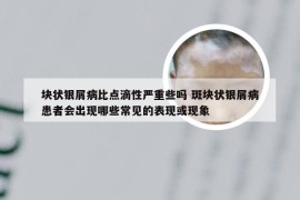 块状银屑病比点滴性严重些吗 斑块状银屑病患者会出现哪些常见的表现或现象