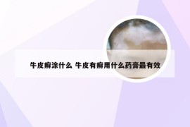 牛皮癣涂什么 牛皮有癣用什么药膏最有效