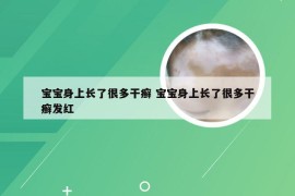 宝宝身上长了很多干癣 宝宝身上长了很多干癣发红