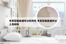 寻常型银屑病可以吹风吗 寻常型银屑病可以上夜班吗