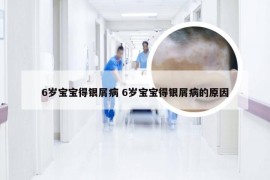 6岁宝宝得银屑病 6岁宝宝得银屑病的原因