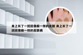 身上长了一团团像癣一样的皮肤 身上长了一团团像癣一样的皮肤病