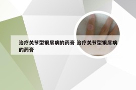 治疗关节型银屑病的药膏 治疗关节型银屑病的药膏