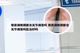 银屑病晚期都会关节病变吗 银屑病晚期都会关节病变吗能治好吗