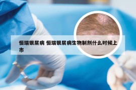 恒瑞银屑病 恒瑞银屑病生物制剂什么时候上市