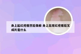 身上起红疙瘩然后像癣 身上出现红疙瘩后又成片是什么