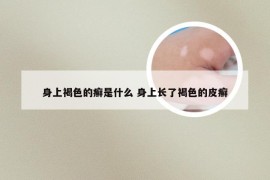 身上褐色的癣是什么 身上长了褐色的皮癣