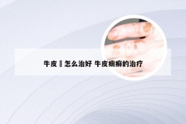 牛皮廯怎么治好 牛皮癍癣的治疗