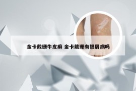 金卡戴珊牛皮癣 金卡戴珊有银屑病吗