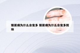 银屑病为什么会变多 银屑病为什么会变多斑块