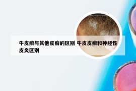 牛皮癣与其他皮癣的区别 牛皮皮癣和神经性皮炎区别