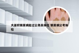 大面积银屑病能过公务员体检 银屑病公考体检