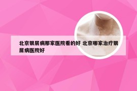 北京银屑病那家医院看的好 北京哪家治疗银屑病医院好