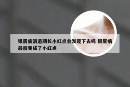 银屑病消退期长小红点会发现下去吗 银屑病最后变成了小红点