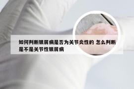 如何判断银屑病是否为关节炎性的 怎么判断是不是关节性银屑病