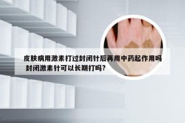 皮肤病用激素打过封闭针后再用中药起作用吗 封闭激素针可以长期打吗?