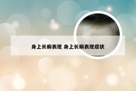 身上长癣表现 身上长癣表现症状