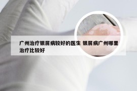 广州治疗银屑病较好的医生 银屑病广州哪里治疗比较好