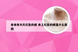 身体有大片红色的癣 身上红色的癣是什么原因