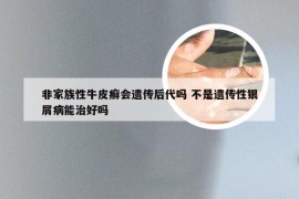 非家族性牛皮癣会遗传后代吗 不是遗传性银屑病能治好吗