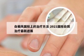 白癜风国际上的治疗方法 2021国际白斑治疗最新进展