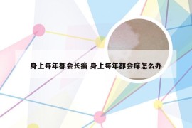 身上每年都会长癣 身上每年都会痒怎么办