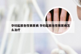 孕妇起脓包性银屑病 孕妇起脓包性银屑病怎么治疗