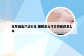 银屑病治疗后脱皮 银屑病治疗后脱皮痒怎么办