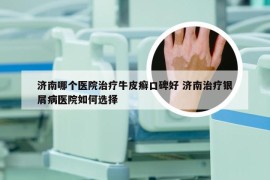 济南哪个医院治疗牛皮癣口碑好 济南治疗银屑病医院如何选择