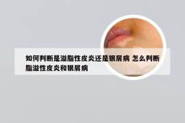 如何判断是溢脂性皮炎还是银屑病 怎么判断脂溢性皮炎和银屑病