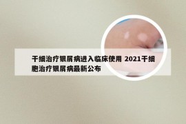 干细治疗银屑病进入临床使用 2021干细胞治疗银屑病最新公布