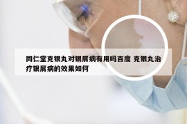 同仁堂克银丸对银屑病有用吗百度 克银丸治疗银屑病的效果如何