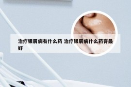 治疗银屑病有什么药 治疗银屑病什么药膏最好