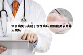 银屑病关节炎属于慢性病吗 银屑病关节炎算大病吗