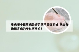 重庆哪个银屑病最好的医院是哪家好 重庆有治银宵病的专科医院吗?