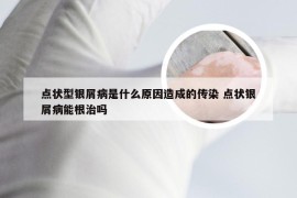 点状型银屑病是什么原因造成的传染 点状银屑病能根治吗