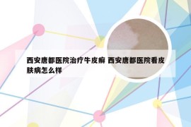 西安唐都医院治疗牛皮癣 西安唐都医院看皮肤病怎么样