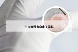 牛皮癣没有白皮了发红