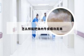 怎么样能把体内牛皮癣攻出来