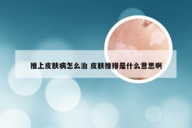 推上皮肤病怎么治 皮肤推排是什么意思啊