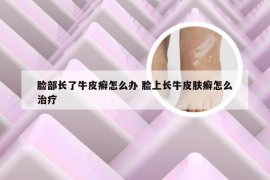 脸部长了牛皮癣怎么办 脸上长牛皮肤癣怎么治疗