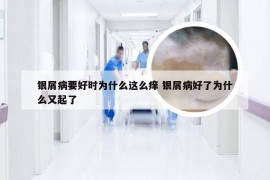 银屑病要好时为什么这么痒 银屑病好了为什么又起了