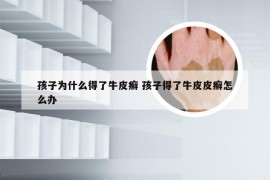 孩子为什么得了牛皮癣 孩子得了牛皮皮癣怎么办