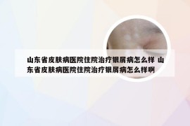 山东省皮肤病医院住院治疗银屑病怎么样 山东省皮肤病医院住院治疗银屑病怎么样啊