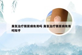 臭氧治疗银屑病有用吗 臭氧治疗银屑病有用吗知乎