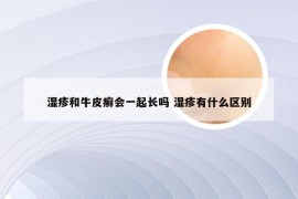 湿疹和牛皮癣会一起长吗 湿疹有什么区别