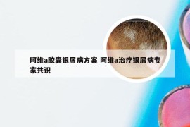 阿维a胶囊银屑病方案 阿维a治疗银屑病专家共识