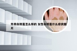 外阴白斑是怎么样的 女性白斑是什么症状图片