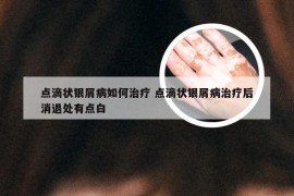 点滴状银屑病如何治疗 点滴状银屑病治疗后消退处有点白