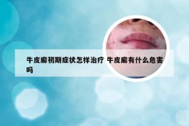 牛皮廨初期症状怎样治疗 牛皮廨有什么危害吗